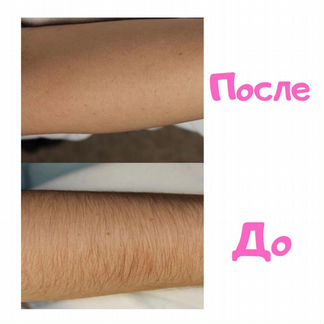 Шугаринг